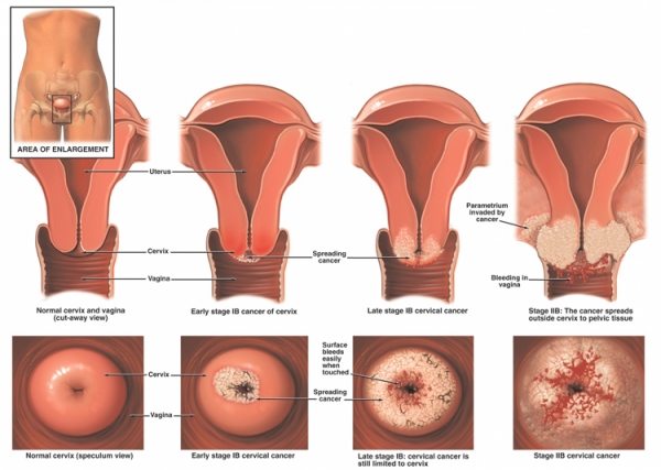 cancerului de col uterin