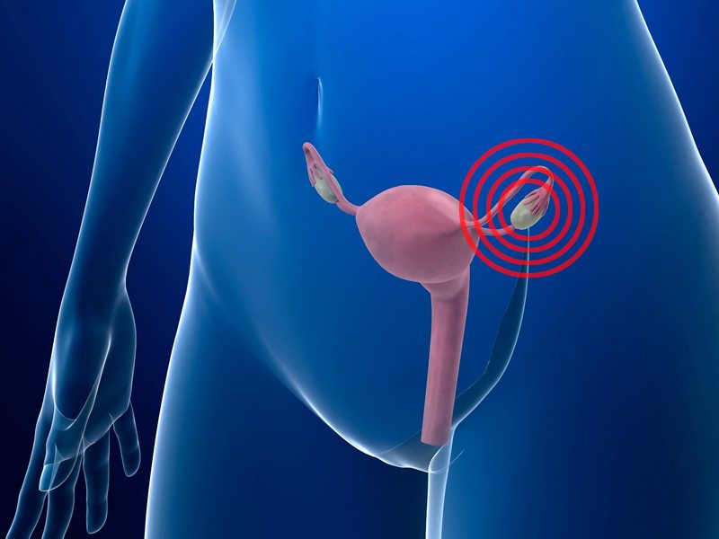 Un nou tratament pentru cancerul ovarian