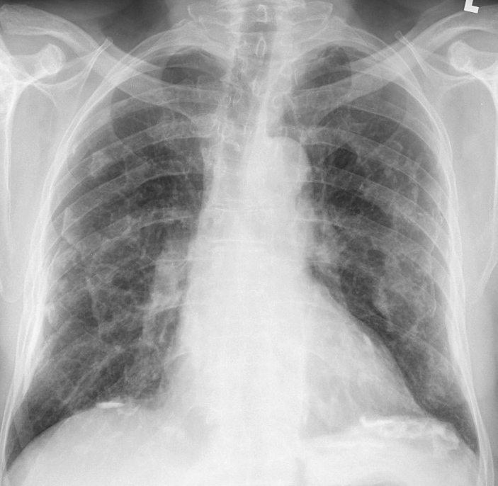 Fibroza pulmonara