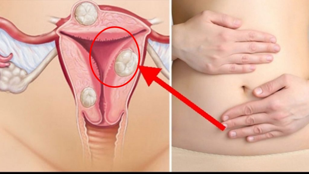 Ce este endometrioza si de ce se mai numeste si boala „femeilor neiubite