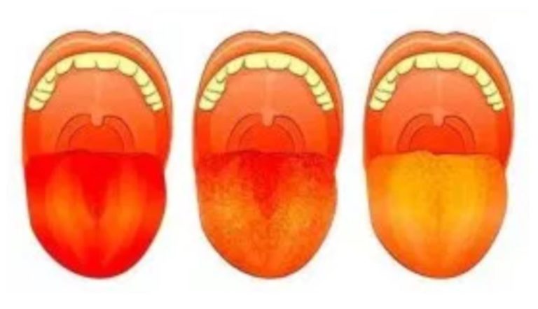 Acorda atentie semnelor de pe limba, pentru a afla mai multe despre sanatatea ficatului tau